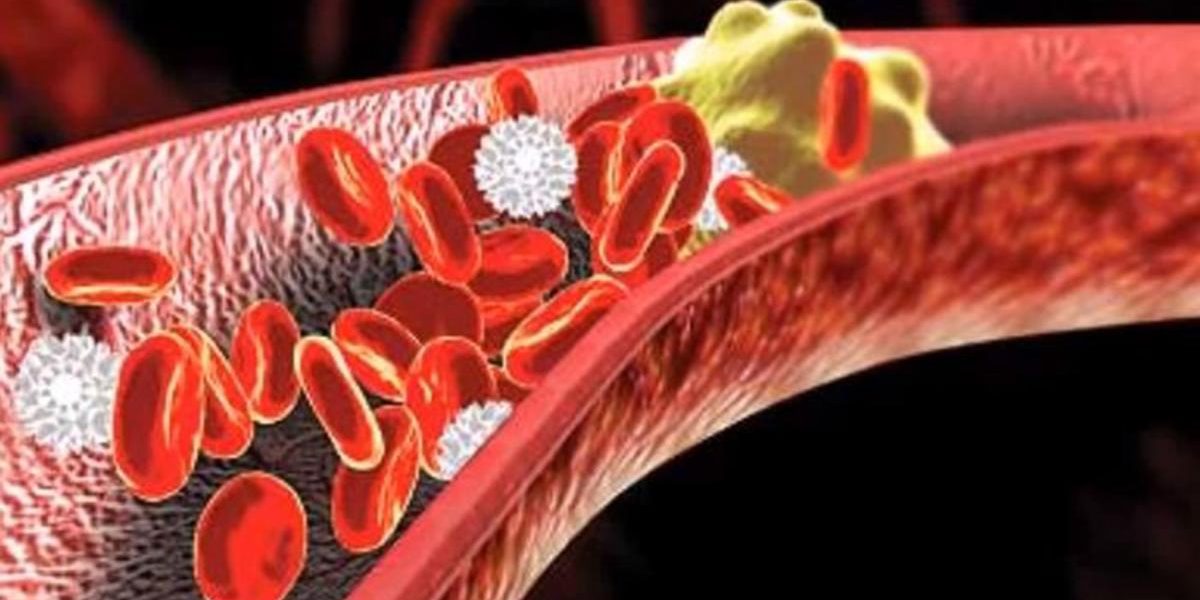 Colesterolo cattivo, prima causa di infarto miocardico