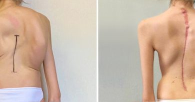 Scoliosi idiopatica: per la prima volta in Italia combinate due tecniche per la correzione di una grave scoliosi in una 15enne 2