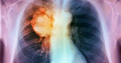 Si arricchisce l'offerta di servizi per i malati di cancro al polmone
