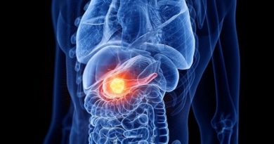 Cancro al pancreas, scoperto come si sviluppano le metastasi