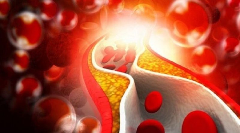 Colesterolo cattivo: nuovo farmaco a mRNA è efficace in 2 pazienti su 3 e lo dimezza con solo due dosi l’anno