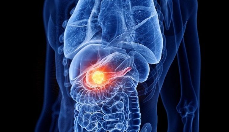 Cancro al pancreas, nuovo bersaglio terapeutico individuato a Verona