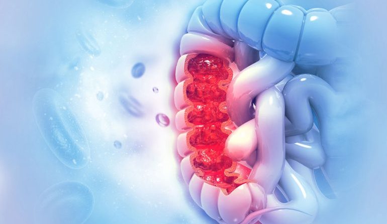 Tumore all'intestino: nuove speranze dal farmaco immunoterapico Pembrolizumab. Potrebbe sostituire la chirurgia